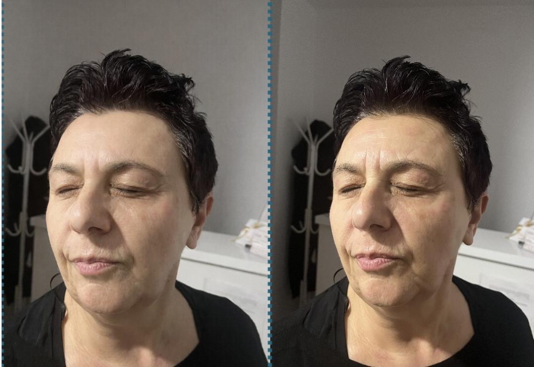 Amelini beauty concept #beograd Dermaroler i dermapen Skinpen-dermapen