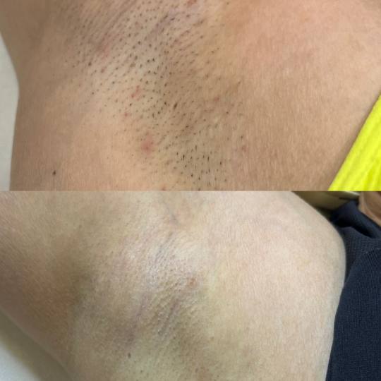 Laser centar Virgo #beograd Laserska epilacija Laserska epilacija pazuha - za dame Prvi/peti tretman