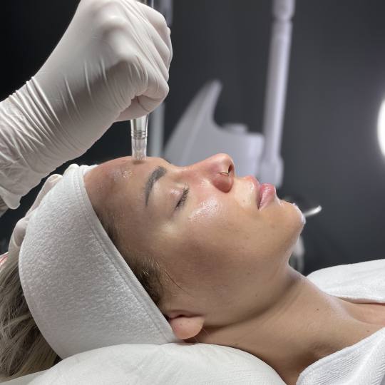 Monika Barta Cosmetics #novisad Dermaroler i dermapen Dermapen tretman lica