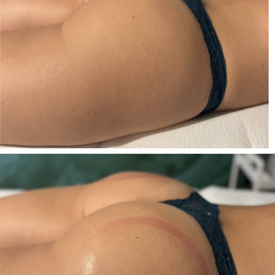 Beauty and nutrition #beograd Mršavljenje Brazilsko podizanje gluteusa - paket od 10 tretmana Telo