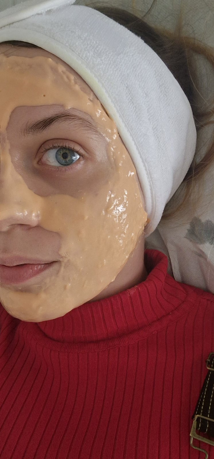 Emilly #beograd Tretman lica Biorevitalizacija lica
