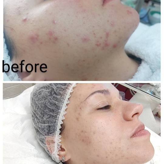 La Prima #beograd Tretman lica Hemiski piling - Black peel 📣📣Hemijski piling Black Natural Pee