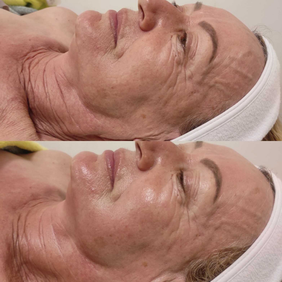 Olja Beauty #beograd Tretman lica Tretman čišćenja lica + fitopiling