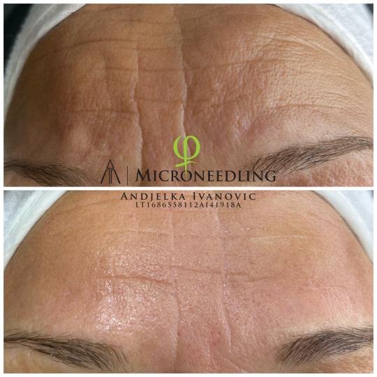 Belle Ana #beograd Tretman lica Microneedling tretman - lice