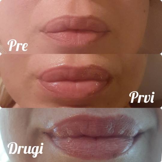Studio Venera J #beograd Tretman lica Derm fix - Hydra lips tretman - tretman za negu ispucalih i suvih usana