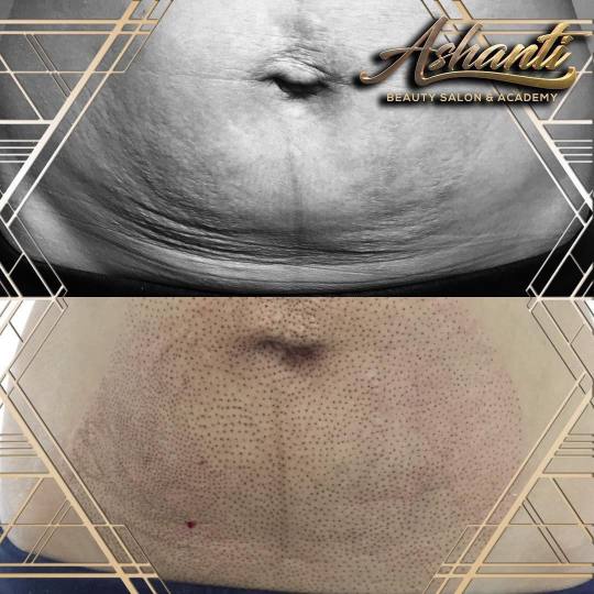Ashanti Beauty Salon & Academy #beograd Tretman lica Plasma pen - stomak