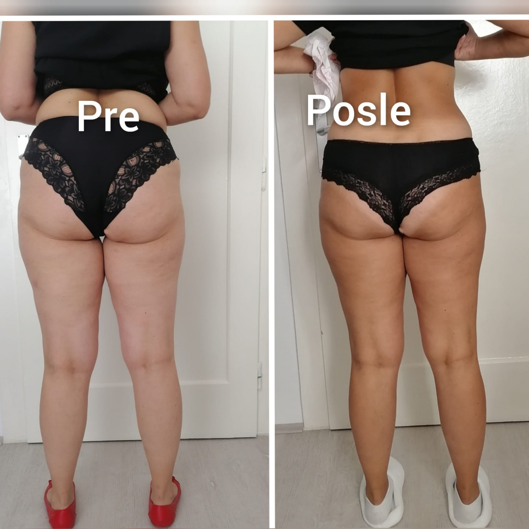 Skinlift Beauty Centar #nis Masaža za mršavljenje 4 tretmana kavitacije + 4 RF + 10 elektrostimulacije