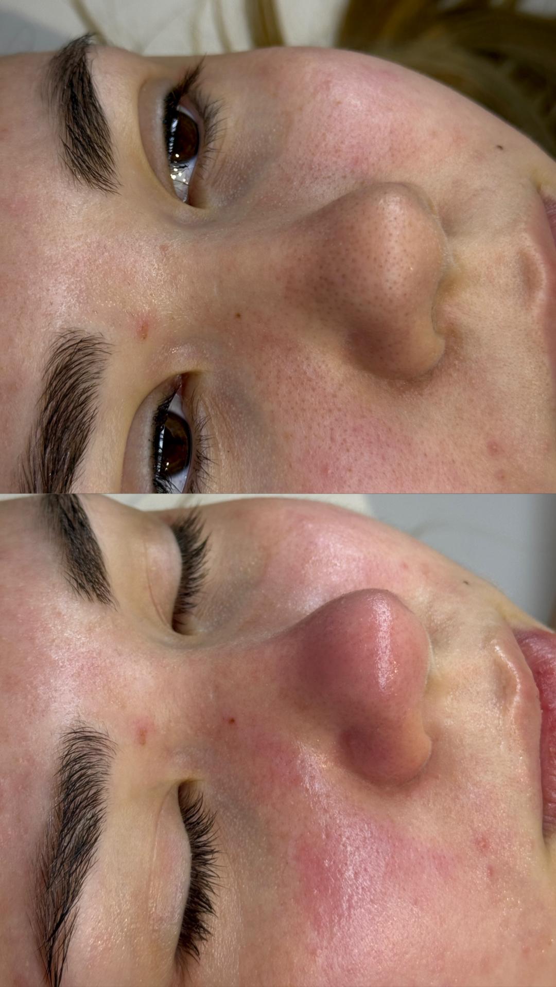 Purete equilibre - higijensko čišćenje lica - Lola esthetic center, Beograd Tretman lica Lice Tretman lica, Beograd, Novi Beograd blokovi, Belville, Savski kej