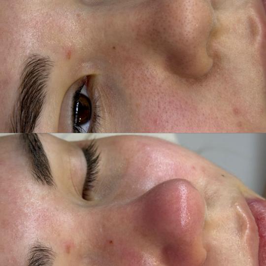 Lola esthetic center #beograd Tretman lica Purete equilibre - higijensko čišćenje lica Higijensko