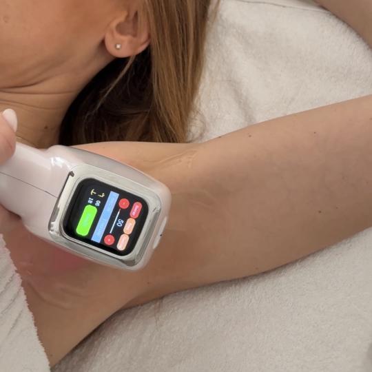 Lola esthetic center #beograd Laserska epilacija Laserska epilacija pazuha - za dame