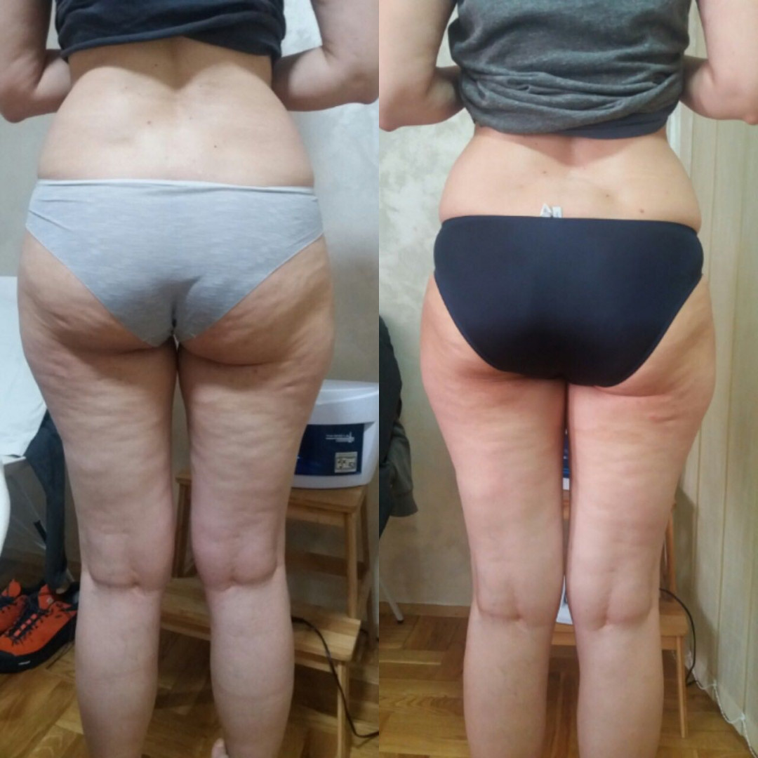 Magdalena 11 #beograd Anticelulit Maderoterapija - 40 minuta