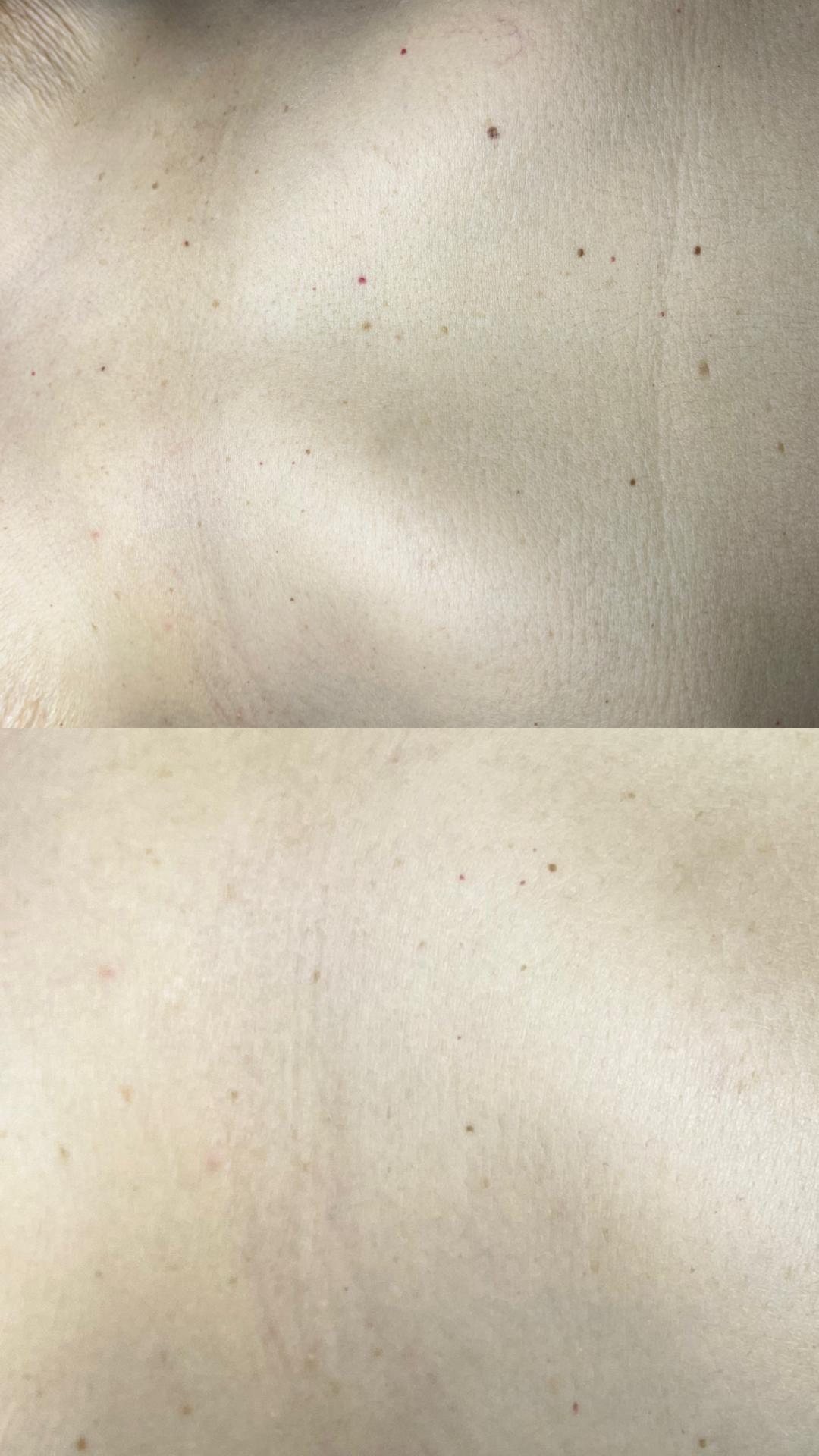 Belle Ana #beograd Tretman lica Phi-Ion tretman - bradavice / papilomi / keratoze / milije / hiperpigmentacija