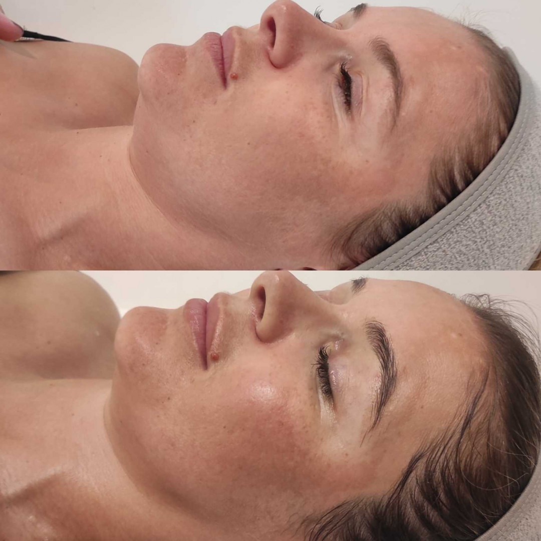 Olja Beauty #beograd Tretman lica Tretman čišćenja lica + fitopiling
