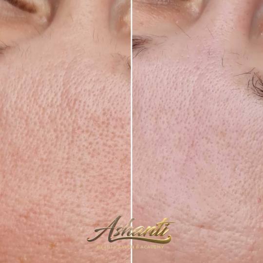 Ashanti Beauty Salon & Academy #beograd Radiotalasni i ultrazvučni tretmani
