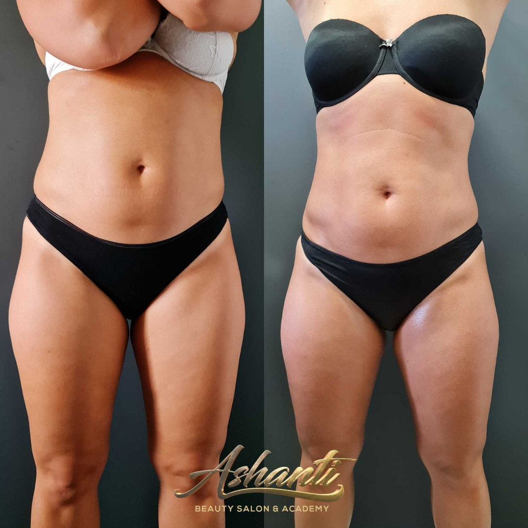 Ashanti Beauty Salon & Academy #beograd Masaža za mršavljenje Dermapen - regija lica