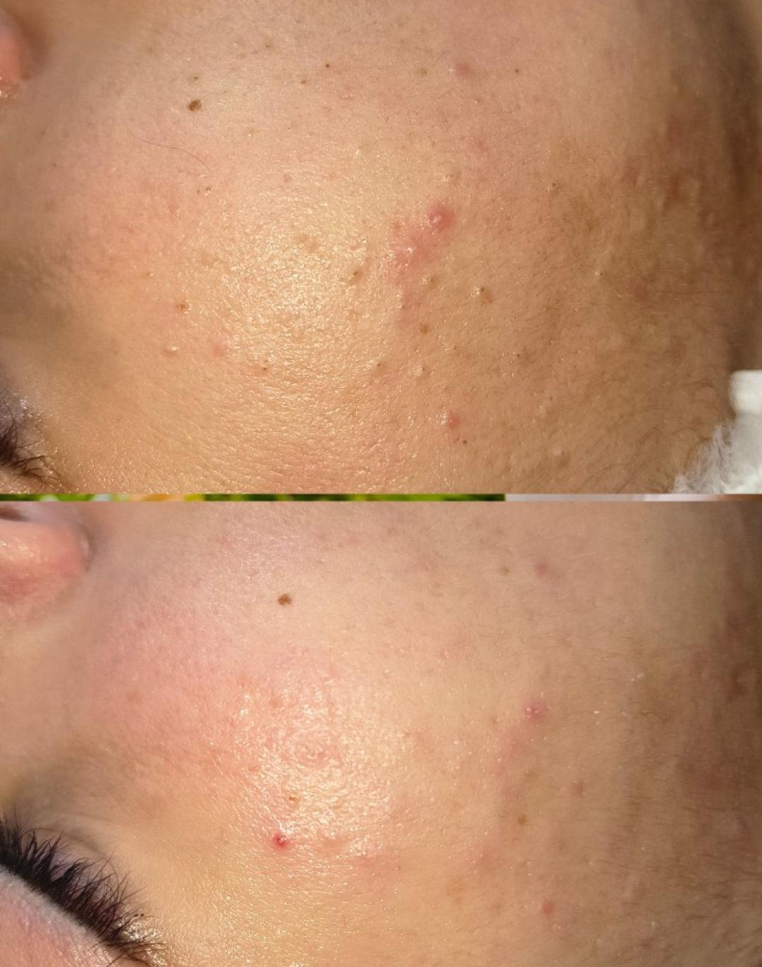 Higijenski tretman lica + ultrazvučna špatula + maska sa algama - Marija beauty and care - Akademija Stefanović, Beograd Tretman lica Lice Tretman lica, Beograd, Krnjača, Ovča, Kotež, Borča