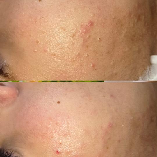 Marija beauty and care - Akademija Stefanović #beograd Tretman lica Higijenski tretman lica + ultra