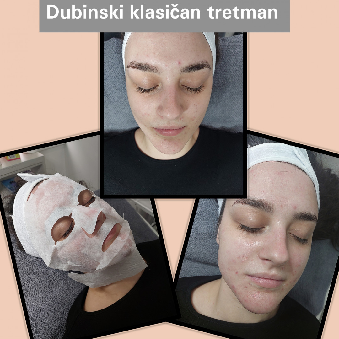 Beauty Palace by M #beograd Tretman lica Klasican tretman+dermoabrazija+uz spatula