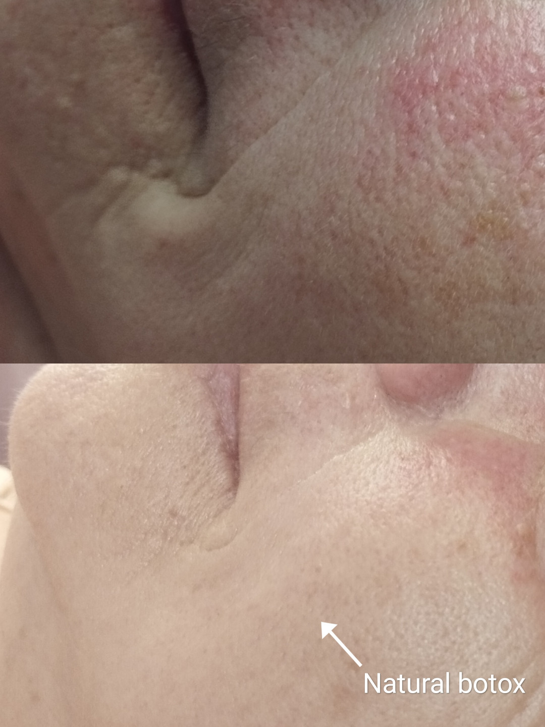 Contessa #novisad Tretman lica Natural botox