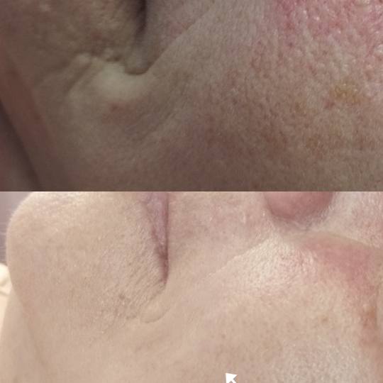 Contessa #novisad Tretman lica Natural botox
