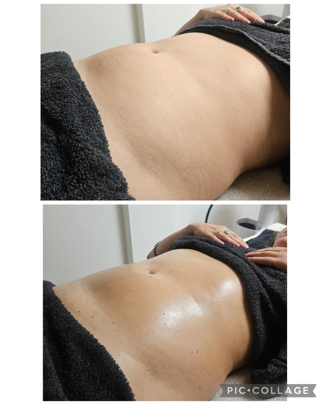 Limfno modelovanje - stomak / bokovi / leđa - Leonis Beauty Premium, Beograd Tretmani tela Telo Tretmani tela, Beograd, Novi Beograd blokovi, Belville, Savski kej