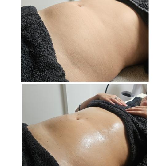Leonis Beauty Premium #beograd Tretmani tela Limfno modelovanje - stomak / bokovi / leđa Tretman na