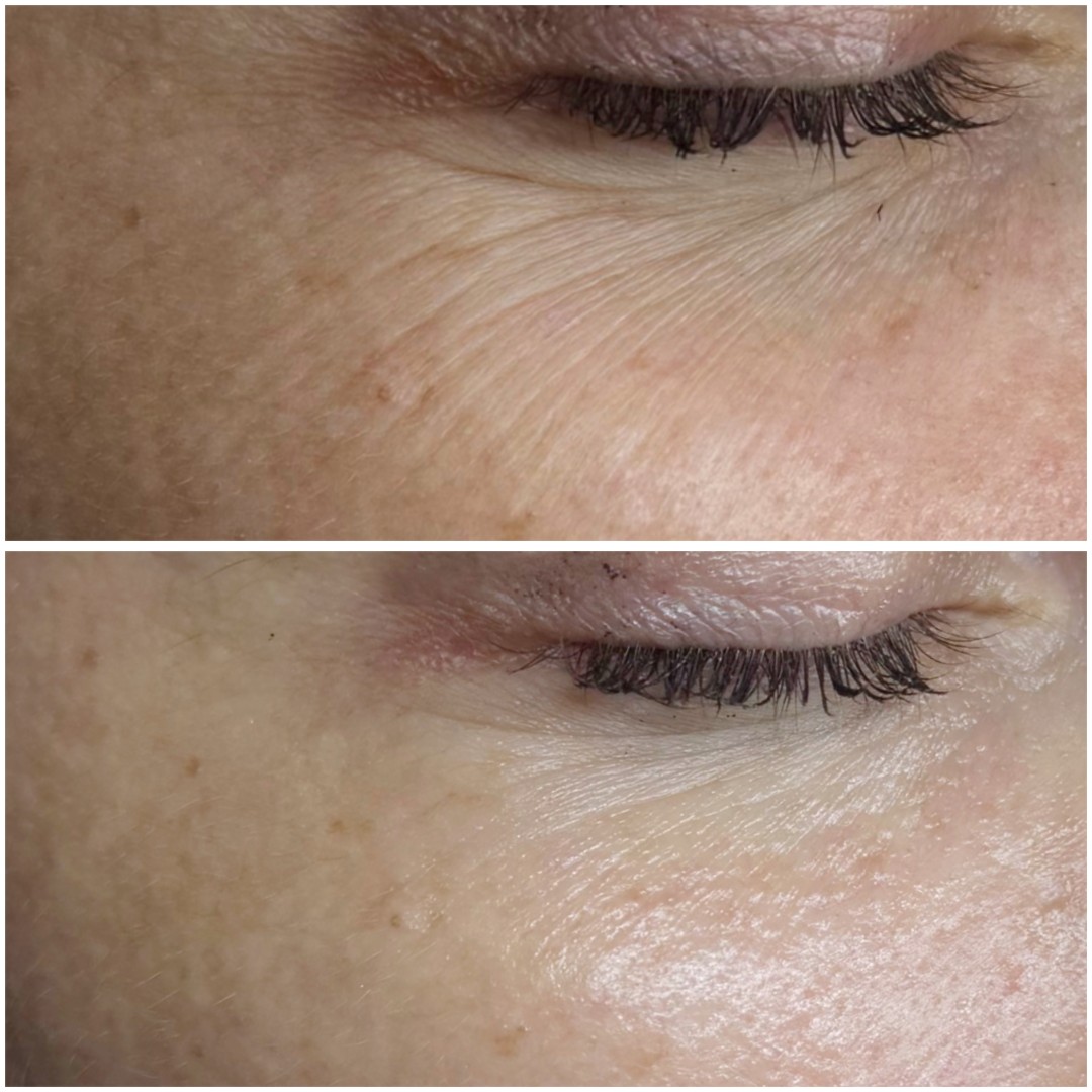 PRX T33 - tretman biorevitalizacije - Kult, Beograd Tretman lica Lice Tretman lica, Beograd, Banovo brdo