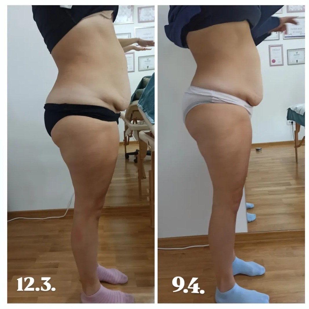 Aj Beauty Centar #pancevo Kavitacija Ultrazvučna kavitacija