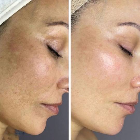 Xenija Beauty Room #beograd Tretman lica Dermapen tretman lica ✨ Derma Pen – put ka savršenoj k