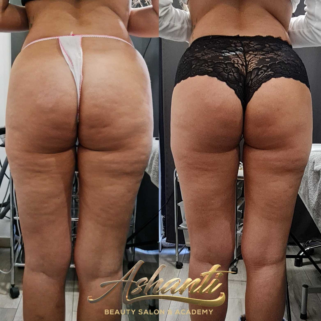 Ashanti Beauty Salon & Academy #beograd Tretmani tela Ultrazvučna kavitacija + radiotalasni lifting - po regiji