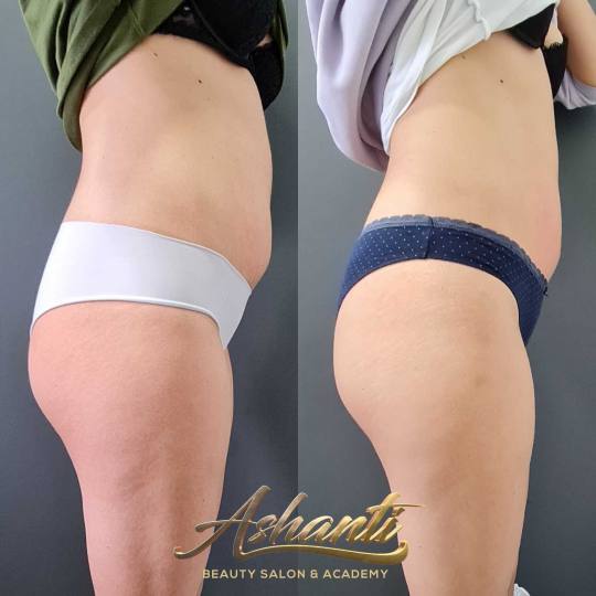 Ashanti Beauty Salon & Academy #beograd Radiotalasni i ultrazvučni tretmani Radiotalasni lifting - 