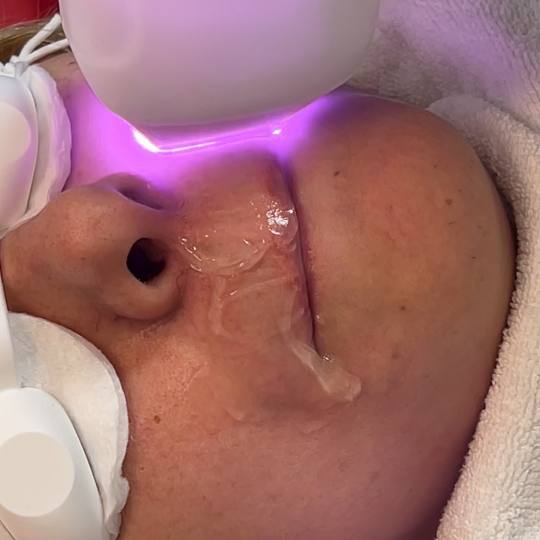 Odraz lepote #beograd Laserska epilacija Laserska epilacija malih regija (nausnice, podbradak, brada