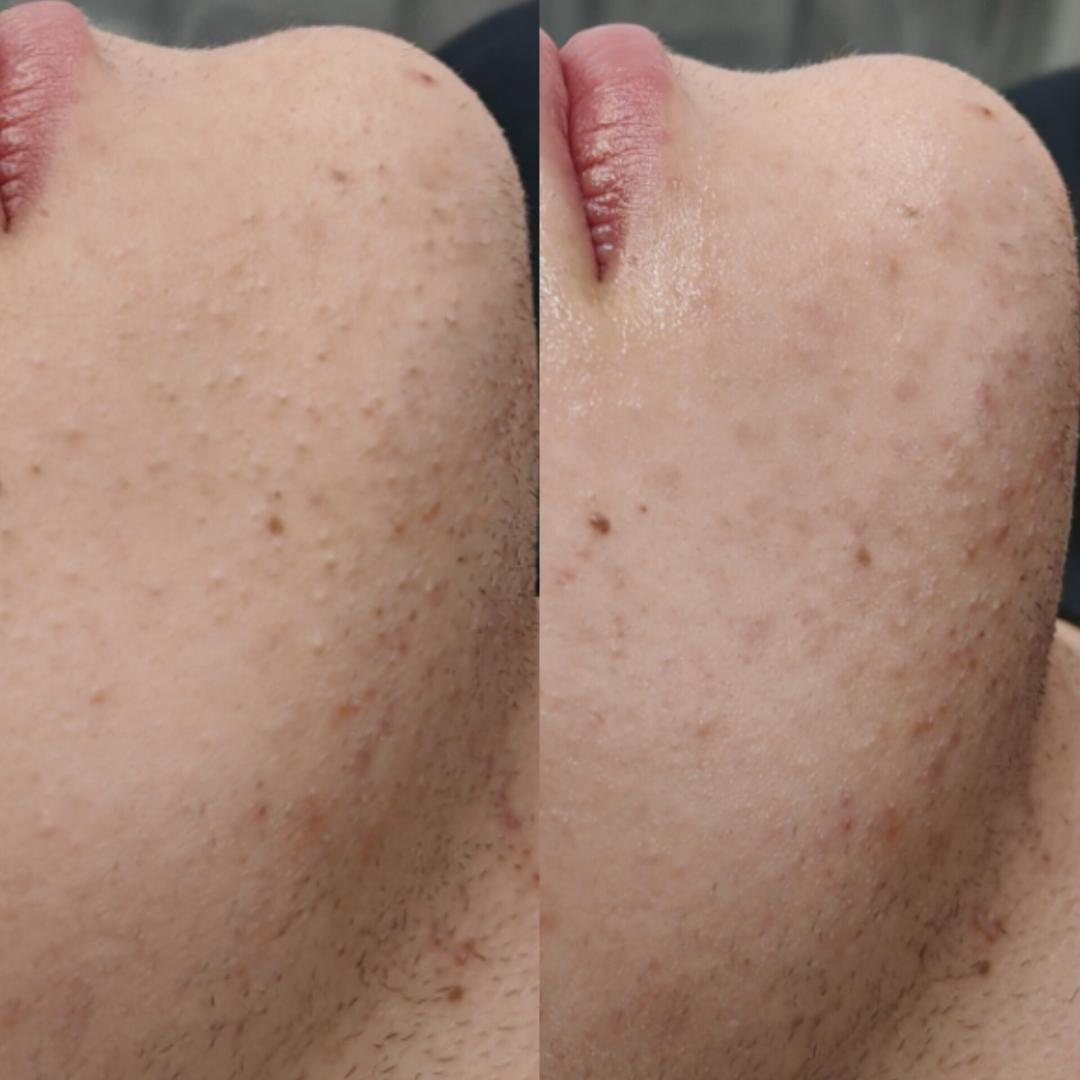 Higijenski tretman lica - Beauty Temple, Niš Tretman lica Lice Tretman lica, Niš, Pantelej