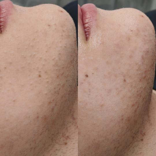 Beauty Temple #nis Tretman lica Higijenski tretman lica Šta postiže higijenski tretman?
✔ dubin