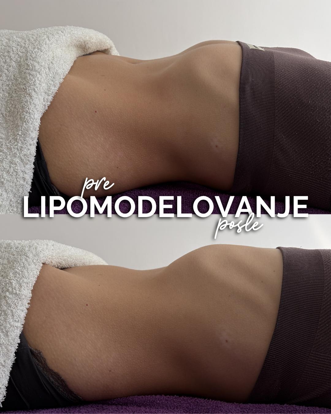 Lipomodelovanje + pakovanje NLL - Natural Beauty Lux, Beograd Anticelulit Telo Anticelulit, Beograd, Bežanijska kosa, Bežanija, Ledine, Surčin