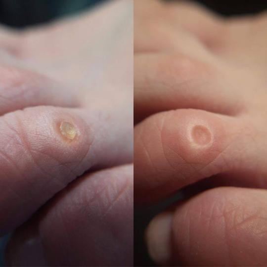 Princess beauty #nis Medicinski pedikir Medicinski pedikir - manje problematičan