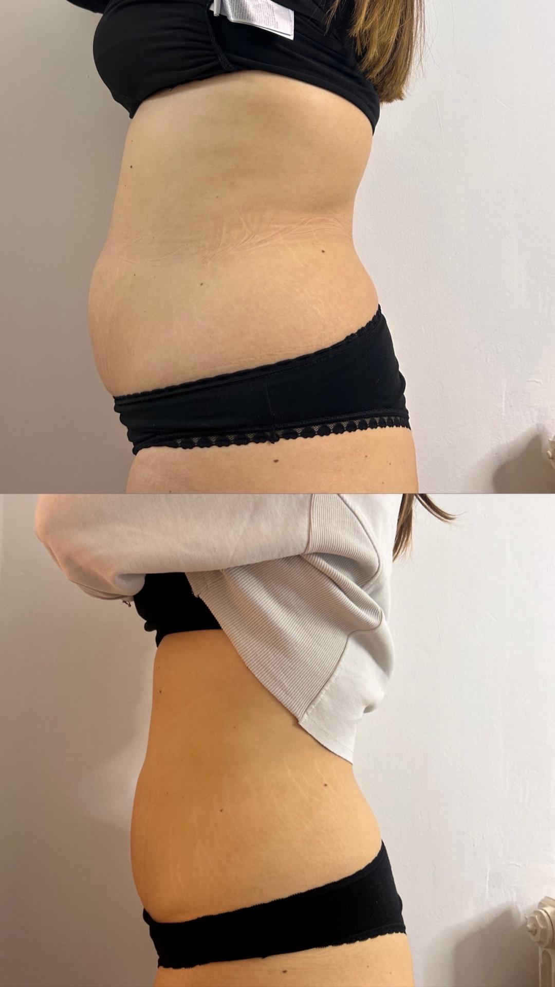 Kavitacija + radiotalasni lifting tela - paket od 3 tretmana - Lara Beauty 037, Kruševac Kavitacija Telo Kavitacija, Kruševac, Centar