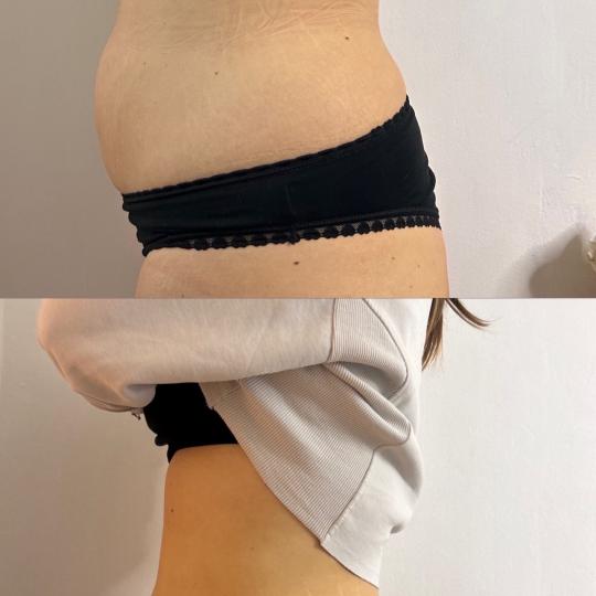 Lara Beauty 037 #krusevac Kavitacija Kavitacija + radiotalasni lifting tela - paket od 3 tretmana