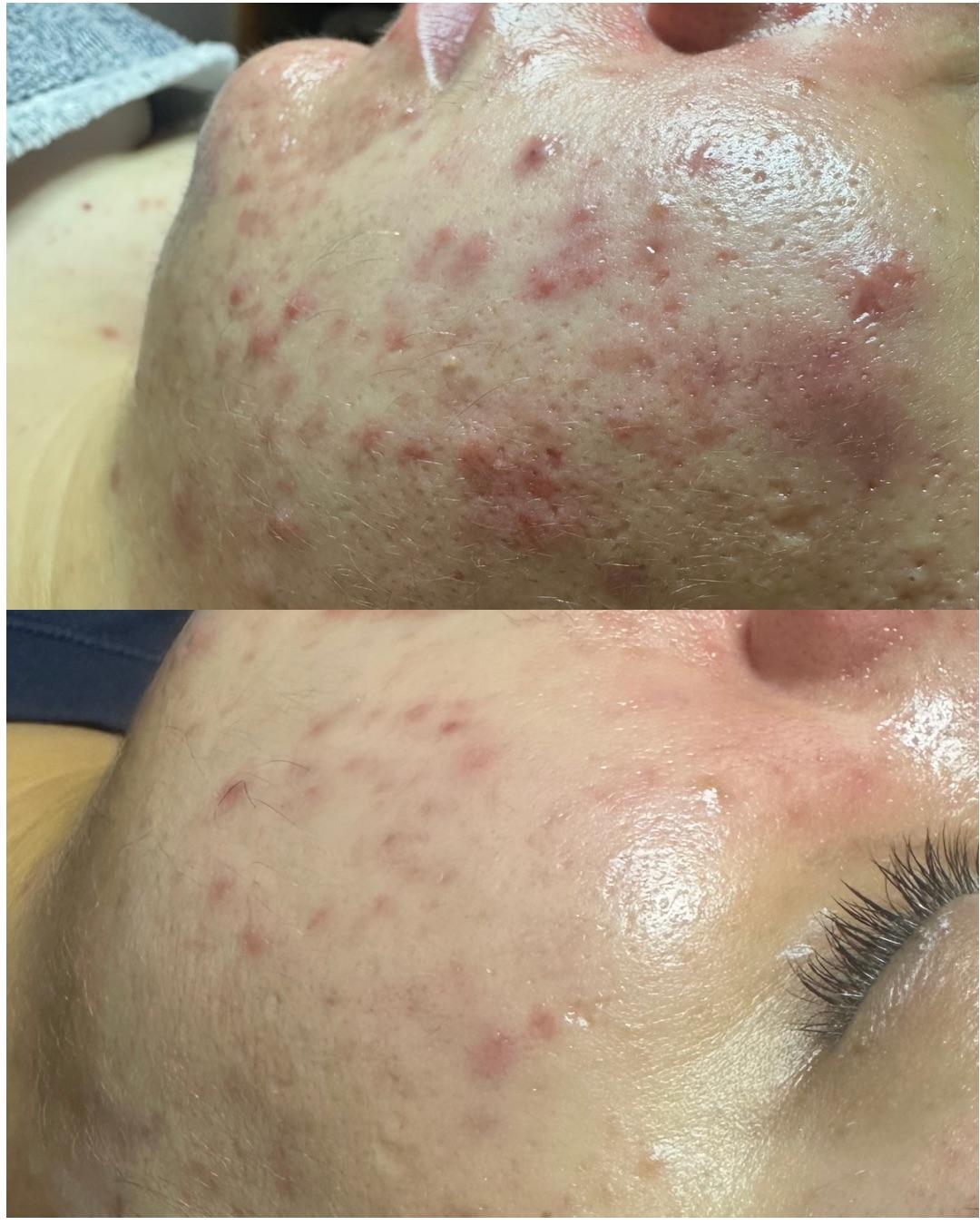 Deep Clean > Higijenski tretman + Hydrafacial + UV špatula - Zen Club, Beograd Tretman lica Lice Tretman lica, Beograd, Vidikovac, Petlovo brdo, Labudovo brdo
