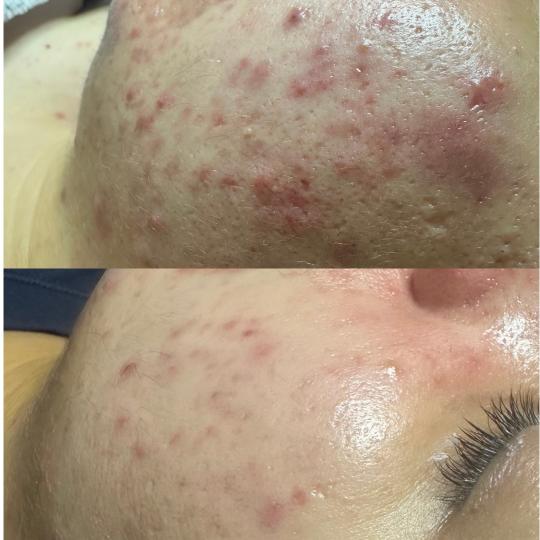 Zen Club #beograd Tretman lica Deep Clean > Higijenski tretman + Hydrafacial + UV špatula Nakon 2 t