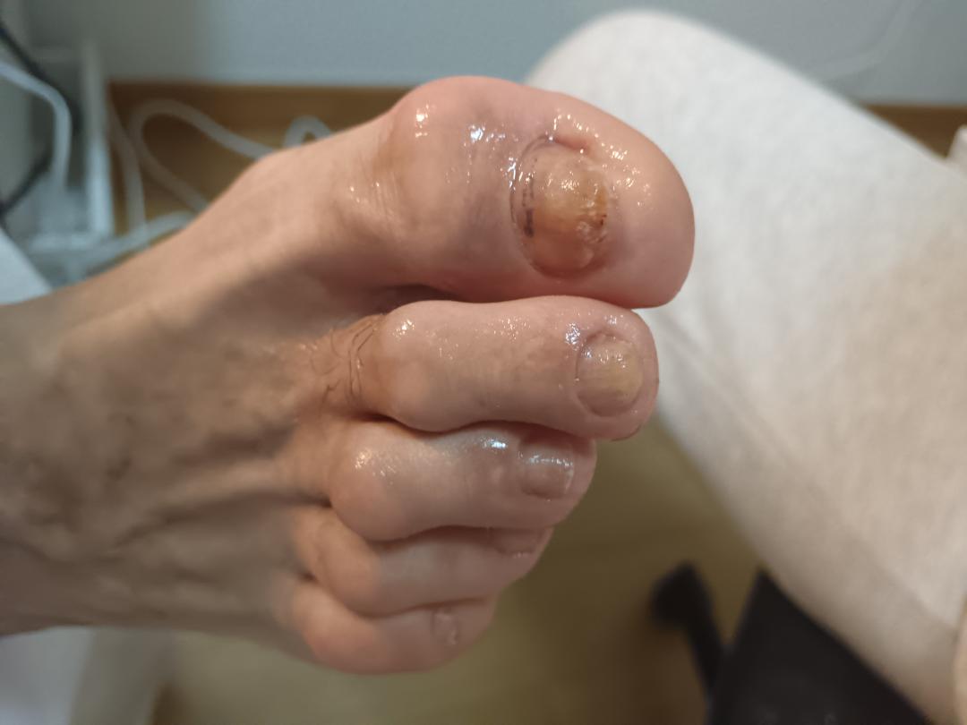 Moja Slavica #beograd Medicinski pedikir Medicinski pedikir