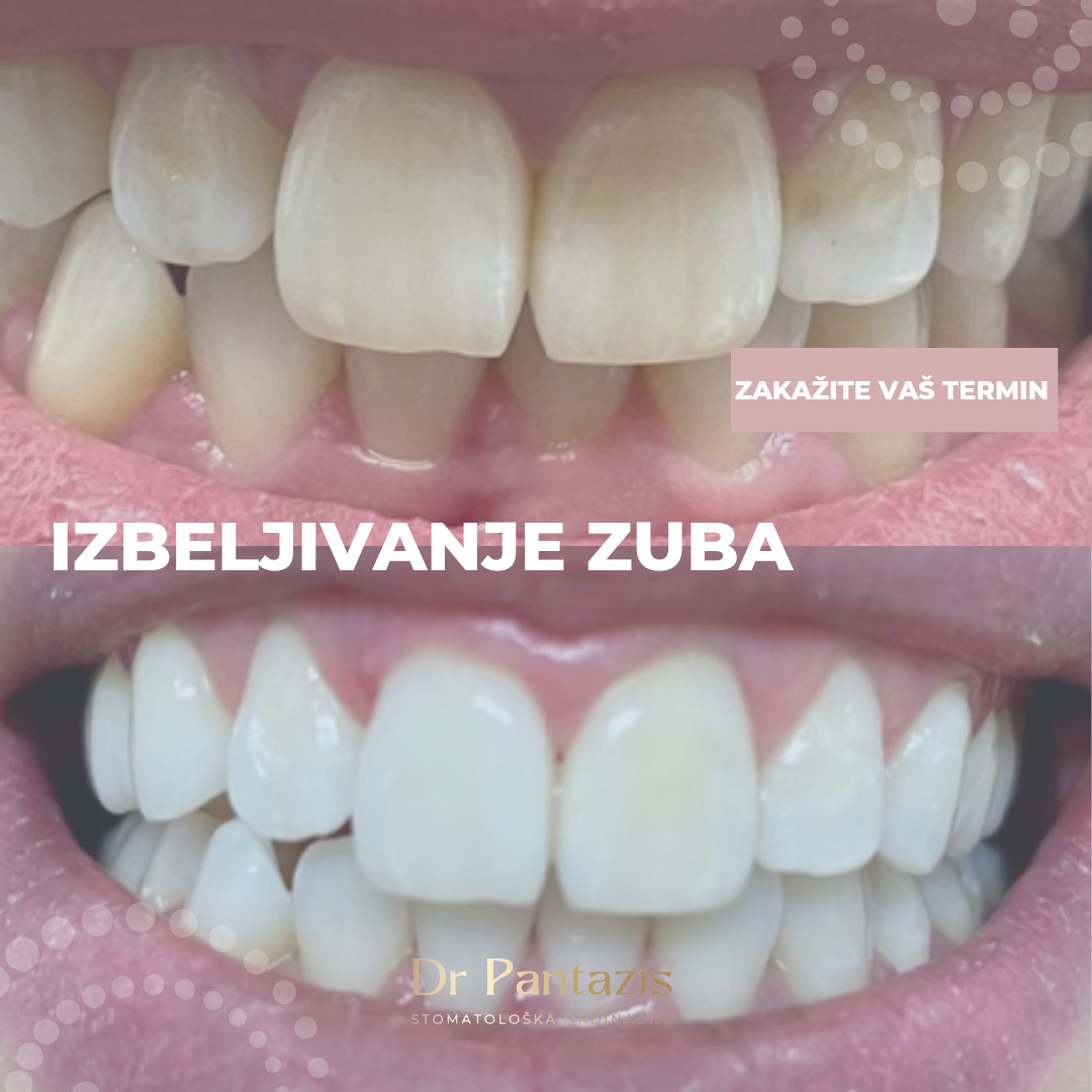 Dr Pantazis - Dental & Beauty Clinic #beograd Zubi Lasersko Profesionalno Izbeljivanje Zuba