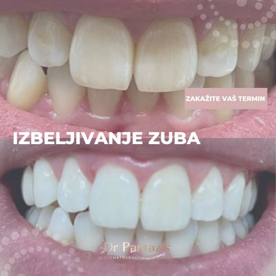 Dr Pantazis - Dental & Beauty Clinic #beograd Zubi Lasersko Profesionalno Izbeljivanje Zuba