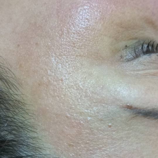 Nadali - Vračar #beograd Tretman lica Tretman lica kiseonikom Lice posle tretmana kiseonikom