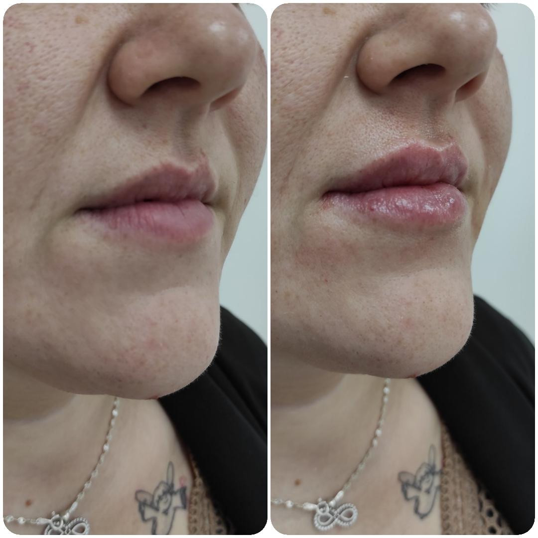 Ordinacija Stanojlović #krusevac Dermalni fileri Hijaluronski filer 0.5 ml - uvećavanje usana