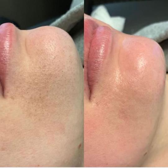 L’Avenue #beograd Tretman lica Higijenski tretman lica