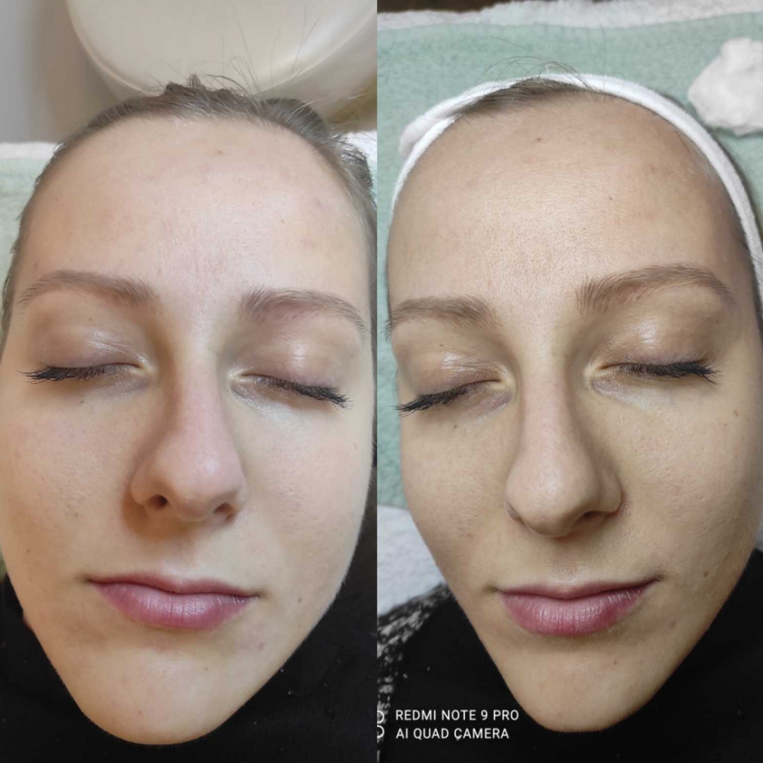 Olja Beauty #beograd Tretman lica Hemijski piling