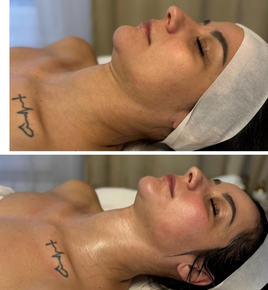 Beauty and nutrition #beograd Lifting / zatezanje kože DIVINE Face masaža lica po metodi Manuele Shale