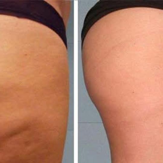 Astradas 2 #beograd Anticelulit masaža Anticelulit masaža