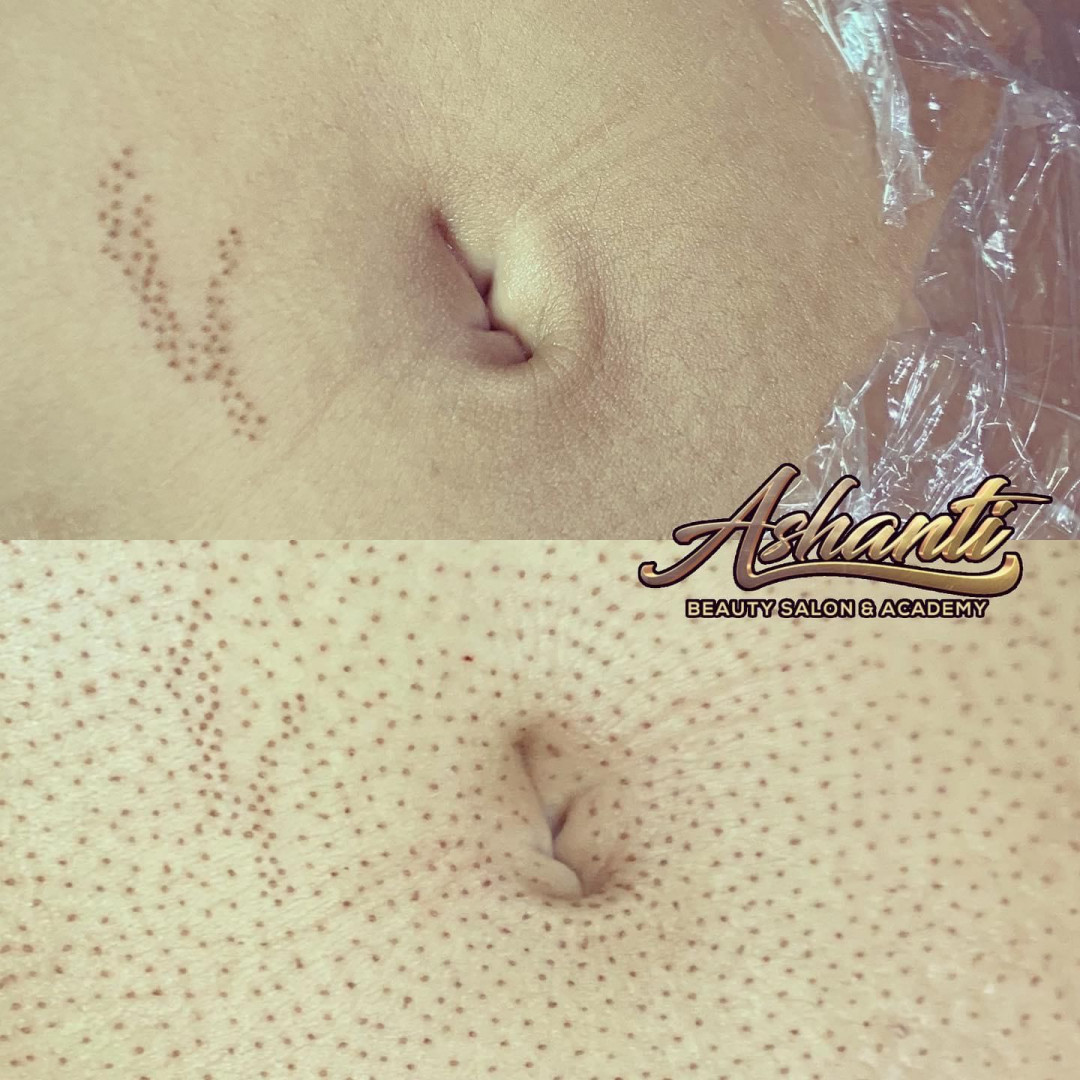 Plasma pen - stomak - Ashanti Beauty Salon & Academy, Beograd Tretman lica Lice Tretman lica, Beograd, Voždovac